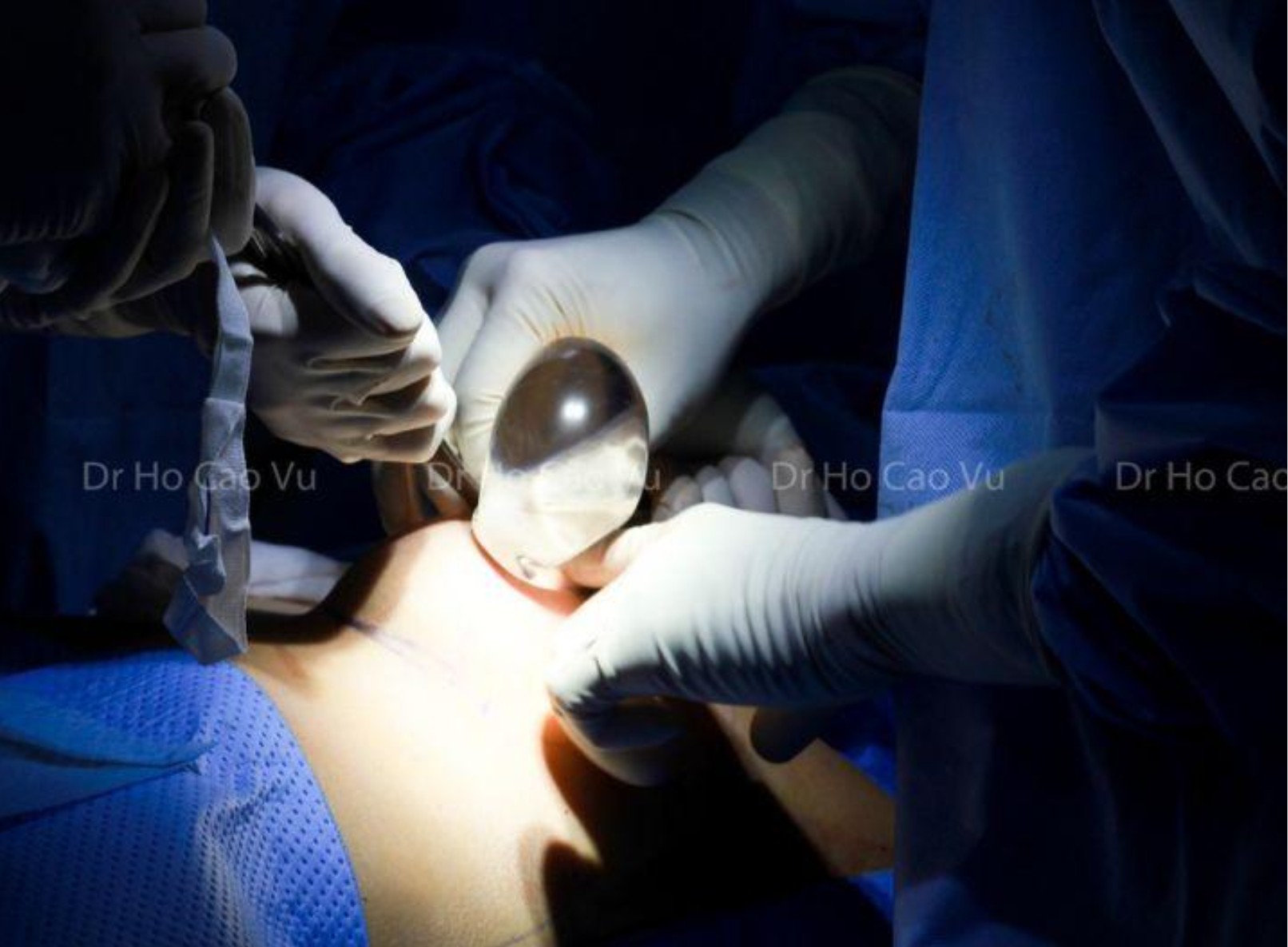 ung-dung-gay-me-mask-thanh-quan-trong-thao-tui-nguc-giai-phap-nang-cao-do-an-toan-phau-thuat-1023.html